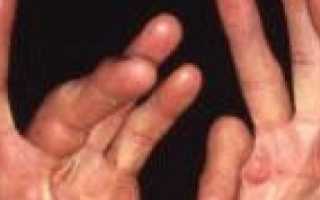 Что такое Контрактура Дюпюитрена? Причины возникновения и способы лечения заболевания сухожилий ладони