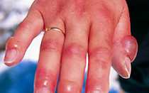 Обморожение: первая помощь, что делать