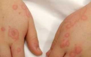 Дерматомиозит у детей и взрослых: что это, симптомы, диагностика, лечение