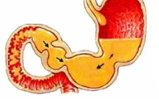 Как вылечить гастрит в домашних условиях?