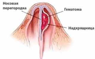 Гематома носовой перегородки