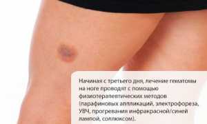 Методы лечения гематомы на ноге