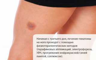 Методы лечения гематомы на ноге