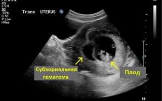 Беременность на раннем сроке и гематома. Есть ли шансы?