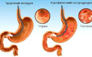 Что такое хронический гастродуоденит