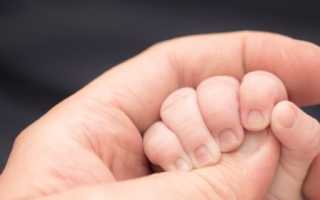 Вариант брахидактилии: укороченная фаланга большого пальца руки