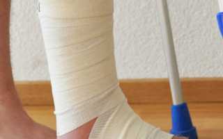 Методы лечения ушиба ноги с отечностью