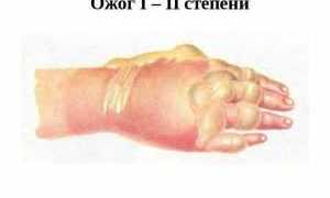 Пузыри после ожога