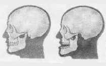 Вывих нижней челюсти