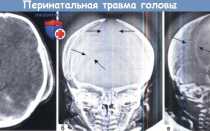 Кефалогематома у ребенка