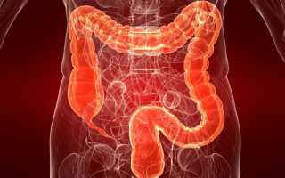Язвенный колит кишечника — что это такое?