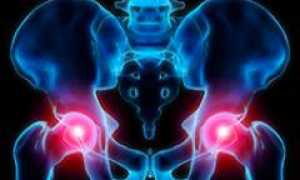 Вывих бедренного сустава (бедра)