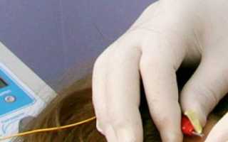 Проведение внутритканевой электростимуляции по методу Герасимова