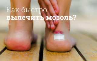 Как быстро вылечить мозоль?