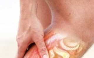 Причины, по которым болит икра на ноге при ходьбе или в покое