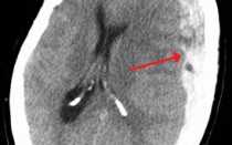 Субдуральная гематома