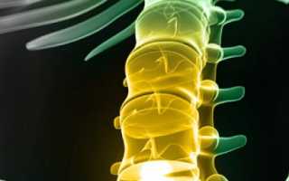 Симптомы и лечение корешкового синдрома шейного, грудного и поясничного отделов позвоночника